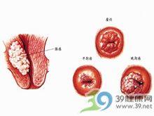 女性宫颈癌图片大全