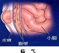 腹股沟疝的护理?