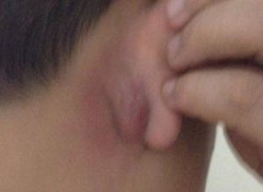 外耳道炎症吃什么药？